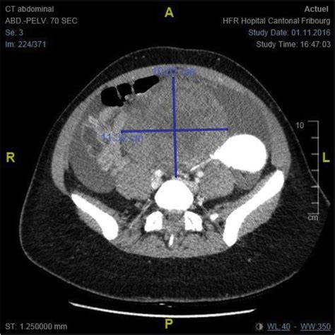 the ct scan shows a voluminous pelvic mass of 98 × 112 × 125 mm download scientific diagram