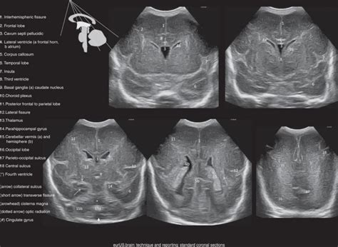Caudate Nucleus Basal Ganglia Occipital Lobe Corpus Callosum