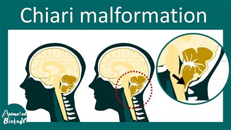 Chiari Malformation And Treatment Type I And Ii Chiari Malformation