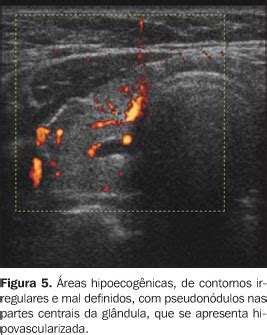 Radiologia Brasileira Achados Ultra Sonogr Ficos Na Tireoidite