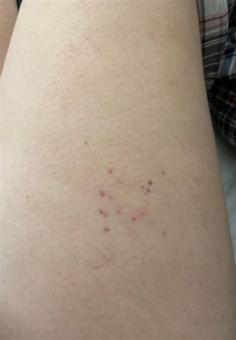 Is This Petechiae Appeared On My Thigh Overnight Rskin