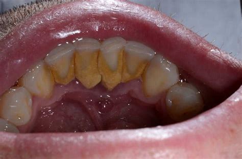 Gum Disease Gum Disease Treatment Gum Disease Dentist