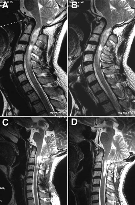 A And B Preoperative Sagittal T2 Weighted Mr Images Showing The
