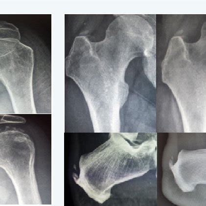 Radiological Calcification Change Of Some Tendons Before And After Download Scientific Diagram