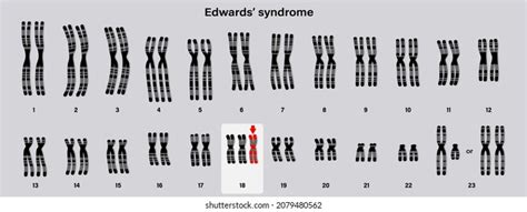 Edwards Syndrome Images Stock Photos D Objects Vectors