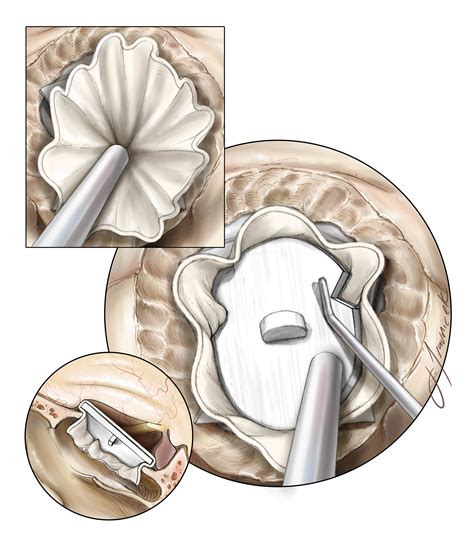 Skull Base Reconstruction And Csf Leak Repair The Neurosurgical Atlas