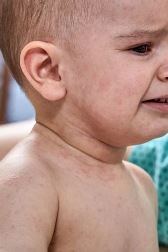 Roseola Rash A Viral Rash On The Skin Of A Child Stock Photo Download