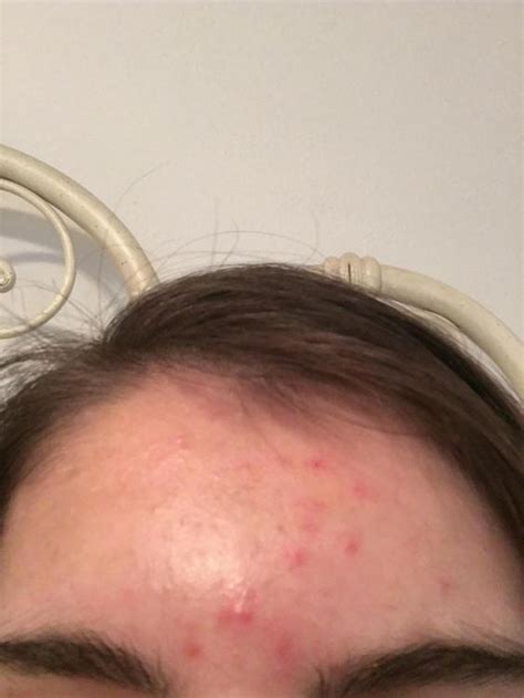 Bumps And Acne Only On The Forehead General Acne Discussion
