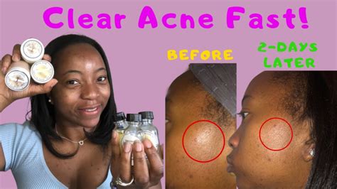 Black Owned Skin Care Product For Acne Prone Skin Clear Acne Fast With