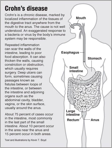 Crohns Disease Basics Health Infographics Crohns Disease