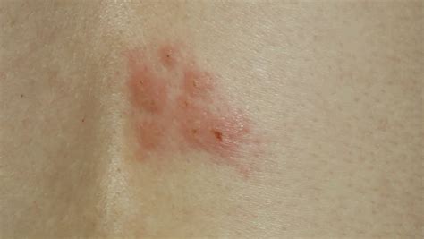 Shingles Rash Stock Footage Video Shutterstock