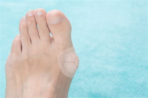 Bunion Pain Relief With Duragel Cushions For Bunions Dr Scholls