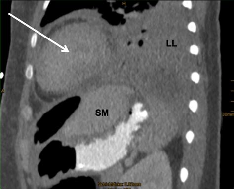 Ct Scan Demonstrating Left Subphrenic Abscess With Destruction Of The