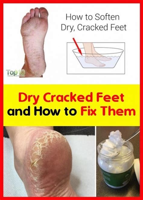 Cracked Feet And How To Fix Them In 2020 Dry Cracked Feet Cracked