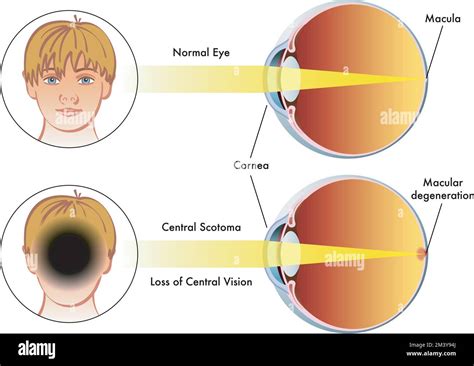 Medical Illustration Compare A Human Eye With Central Scotoma With