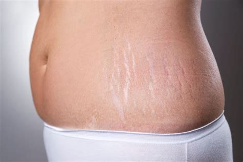How To Get Rid Of Stretch Marks The Ultimate Guide