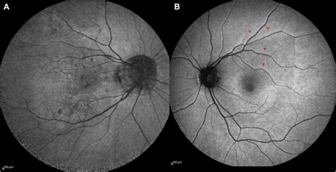 Retinal Displacement After Scleral Buckle Versus Combined Buckle And