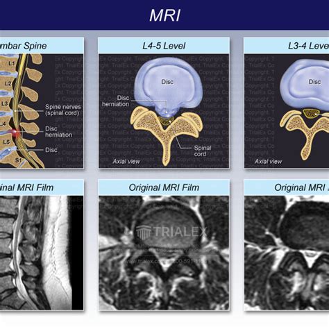 Mri Film Interpretation Of The Lumbar Spine Trialexhibits Inc