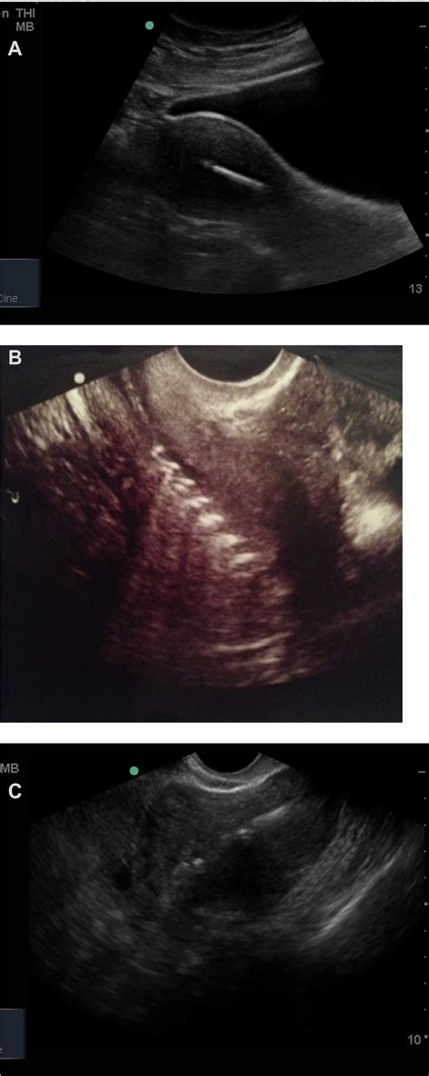 Ultrasound Scan Images Of Intrauterine Iuds And An Ius Notes A