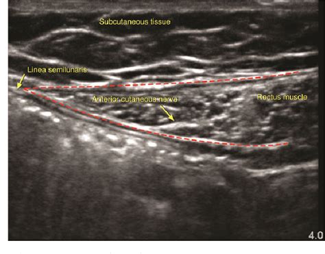 figure 2 from abdominal cutaneous nerve entrapment syndrome semantic scholar