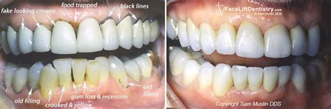 Gum Recession And Black Gum Lines Around Crowned Teeth