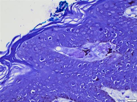 Crystal Violet Stain Showing Amyloid Deposits In The Papillary Dermis