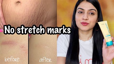 How To Remove Stretch Marks How To Remove Scars Stretch Marks
