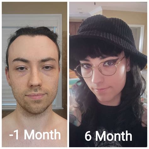 25 Years Old X 29 Years Old 25 Years Hrt And 15 Years Post Ffs R