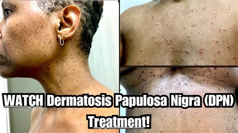 Dermatosis Papulosa Nigra Dpn Treatment 😵😀 Questionanswer Youtube