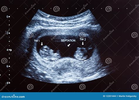 Ultrasound Scan Of 10 Weeks Old Twins Stock Photo Image Of Women