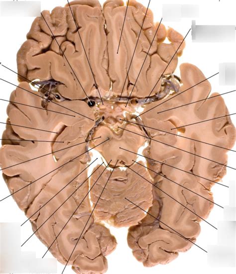 Transverse Slice Of Brain Pt 5 Diagram Quizlet