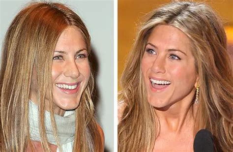 Jennifer Aniston Nose Job Plastic Surgery Before And After Celebie