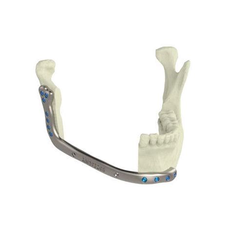 Custom Made Mandibular Implant Xilloc Non Absorbable