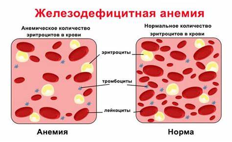 Железодефицитная анемия диета какая Железодефицитная анемия, как распознать и как вылечить – запись к Железодефицитная анемия, как распознать и как вылечить – запись к Железодефицитная анемия диета какая