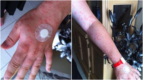 Pregnant Mums Rash Covered Her Whole Body ‘the Pain And