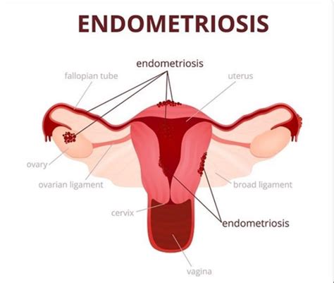 Endometriosis Causes Symptoms Types Treatment And Risk Factors