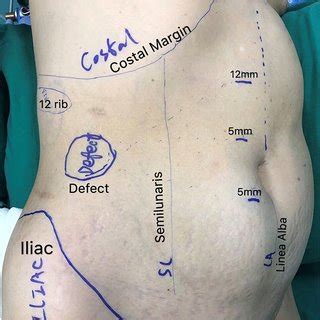 Patient Position And Port Placement For Repair Of A Flank Area Hernia L Download Scientific