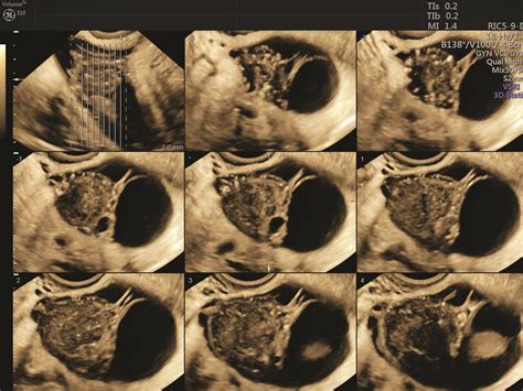 Using Gynecological Ultrasound For A Better Annual Exam Empowered