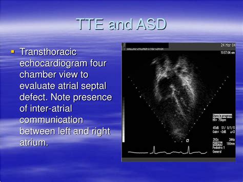 Ppt Atrial Septal Defect Powerpoint Presentation Free Download Id