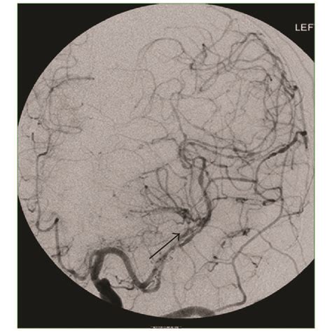 Conventional Cerebral Angiography Revealed A M1 Segments Of The