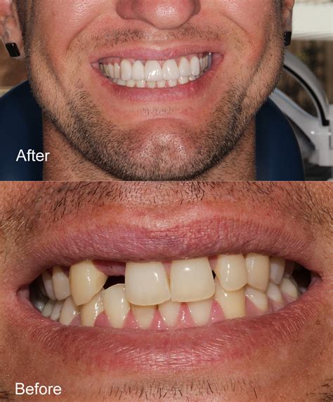 dental implants perth dental at joondalup