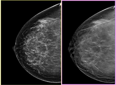 Breast Cancer Awareness 3 D Mammograms Offer Clearer View Of Breast