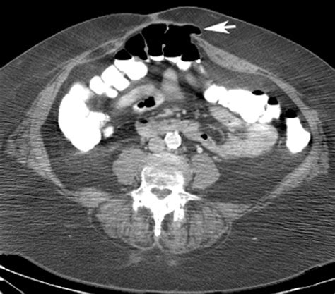 Anterior Abdominal Wall Hernias Findings In Barium Studies Radiographics