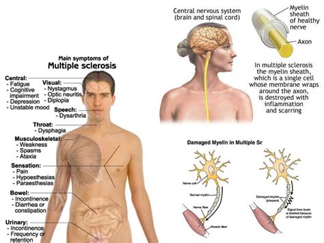 Ms symptoms often worsen when the body temperature rises in some people with ms. Overcoming Multiple Sclerosis - Root Cause Radio