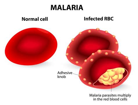 It is manifested by fever along with chills and rigors. Malaria: Causes, Symptoms and Treatments - Medical News Today