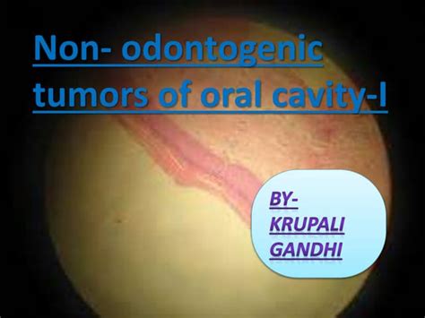 Non Odontogenic Tumors Of Oral Cavity I Ppt
