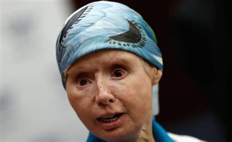 Charla Nash S Body Rejected Her Face Transplant — But The Chimp Attack Suvivor Will Be Ok
