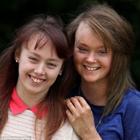 Lamellar Ichthyosisthe Teenage Sisters Who Shed All Their Skin Every