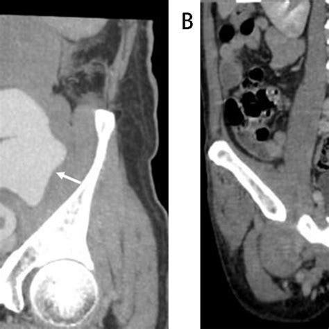 Iliopsoas Abscess Associated With Tuberculous Aortic Aneurysm Patient