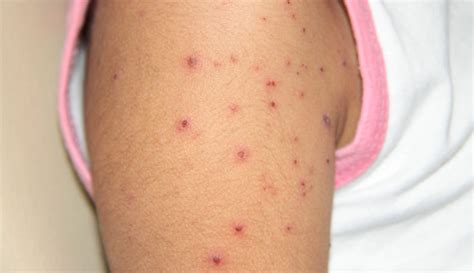 Zona Hastalığı Nasıl Geçer? - Tedavi Yöntemleri ve İyi Gelen Çözümler